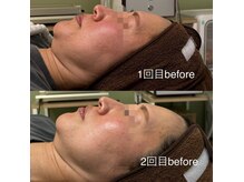 ミヨン(Miyong)/3週間後のリフトアップ！