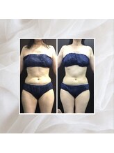 プリマプリート 名駅店/脂肪冷却