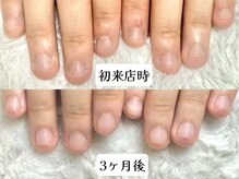 グラシナ なんば店/深爪/自爪育成/フィルイン