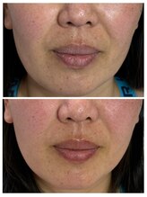 恵比寿脱毛 シーズ(She’s)/ソフトダーマ40代ビフォア