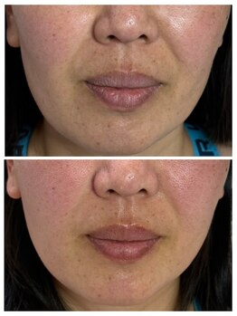 恵比寿脱毛 シーズ(She’s)/ソフトダーマ40代ビフォア