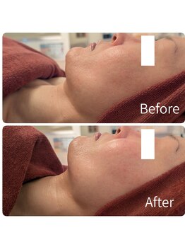 ワイズ(Y's)/ヒト幹細胞培養液導入