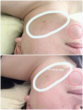 アキュモンド 渋谷院(acumond)/セラピール施術1回での変化