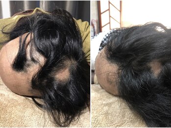 セントラル鍼灸院リラクシー(Re:laxy)/皮膚のただれ抜毛で、すがる思い