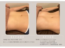 エーシーサロン 六本木店(acsalon)の雰囲気（遺伝子に合わせた施術ならたったの15分でくびれが出現［六本木］）