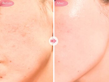 リジェネラティブセル メディカルサロン(Regenerative Cell Medical Salon)の写真/ハリツヤUPを目指す方へ◎エクソソームが土台を整え疲れ顔をケアします♪