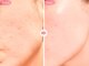リジェネラティブセル メディカルサロン(Regenerative Cell Medical Salon)の写真/ハリツヤUPを目指す方へ◎エクソソームが土台を整え疲れ顔をケアします♪