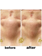 エクスクラメーションマーク(!!!)/韓国肌管理セットのハイドラ