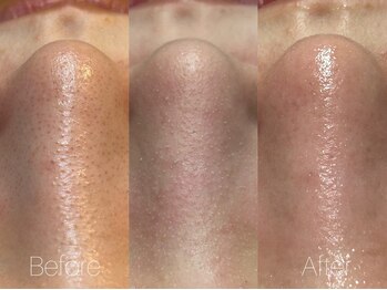 ビヨンド リンク(BEYOND L'INK)/韓国式3D毛穴洗浄