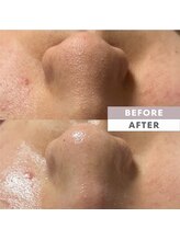 とぅるりん 肌質改善/毛穴つまりもスッキリ♪