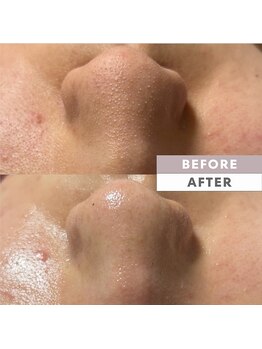 とぅるりん 肌質改善/毛穴つまりもスッキリ♪