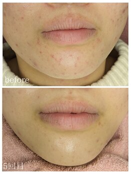 ラミーユ(La Miu)/ハーブピーリング5回目の変化