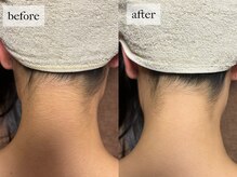 ヒナノ 矢場町店(HINANO)/脱毛