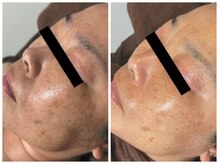 ラキ(LAKI)/ホワイトスノーピール