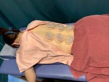 あいの心鍼灸整体院/カッピング