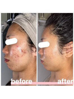 プリマ 大津店(PRIMA)/ニキビ悩みにも当店プラズマ★