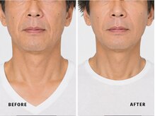 ミネルバ(MINERVA)/施術例 50代男性　フェイシャル