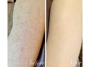 ムム(mumu)の写真/夏までに!!【背中・二の腕のケア】見られても恥ずかしくない素肌に!ザラついた肌の表面が綺麗になります