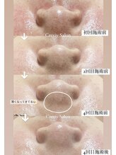 クレヴィー(Creviy)/陶肌トリートメント4回の変化