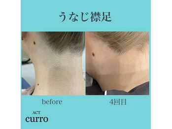 アクト クロ(ACT curro)/【うなじ襟足】脱毛施術例