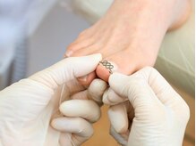 厚木 海老名 巻き爪矯正センター/施術【5.専用器具を装着】