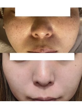 エイチケービューティーサロン(H/K beauty salon)/＼シミ+美白／