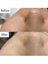 ウルル(ULuLu)/iLLON　ビフォーアフター