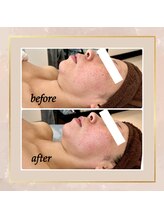 レアーレグロウ(Reale Glow)/Before→After