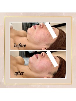 レアーレグロウ(Reale Glow)/Before→After