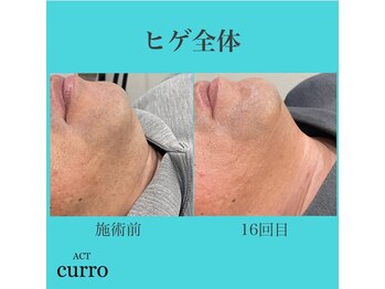 アクト クロ(ACT curro)/【ヒゲ全体】脱毛施術例