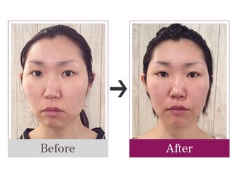 ビコツゼロ 心斎橋(BIKOTSU ZERO)/小顔・頬骨の歪み・顎の歪み