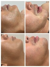 フォー(the 4)/Before After