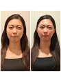 ラ コンシェル たまプラーザ店&nbsp;リフトアップ・小顔効果なら美容鍼！むくみ対策にも！二様鍼