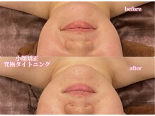 アクトベレッザ(Act BELLEZZA)/むくみ・左右差の改善に小顔矯正