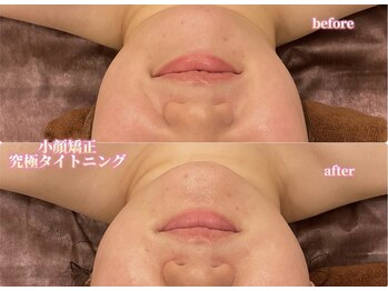 アクトベレッザ(Act BELLEZZA)/むくみ・左右差の改善に小顔矯正