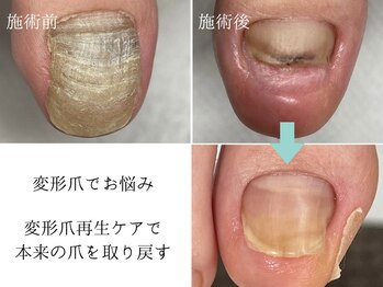 肥厚爪・変形爪ケア