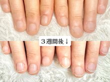 グラシナ なんば店/深爪/自爪育成/フィルイン