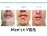 毛穴・肌悩みも改善☆ヒゲ専用モードメンズ脱毛　ヒゲ　30分 M¥7700
