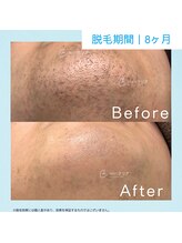メンズクリア 武蔵小杉店/【メンズクリア】お客様の施術例