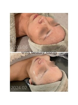 ウィズ(with)/REVIハーブピーリング×フォト