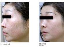 ブロッサム(Blossom)/韓国式白雪肌スノーピーリング