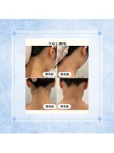 テトテ(tetote)/うなじ脱毛