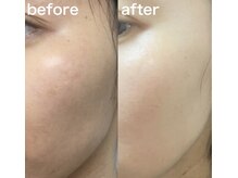 セゾン(Saison)/水光肌ピーリング施術後