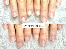 グラシナ なんば店/深爪/自爪育成/フィルイン