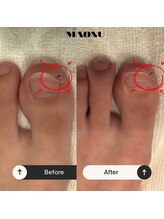 マオヌー(MAONU)/巻き爪ケア【モニター様】