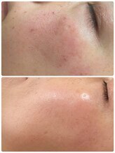 ピーナップ(P-nap)/シミ改善40代