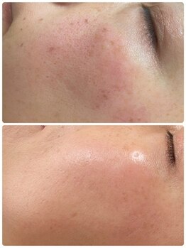 ピーナップ(P-nap)/シミ改善40代