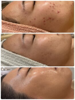 ジャストミービューティー(Just Me Beauty)/肌質改善/毛穴ケア/ニキビケア