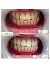 ルブラン 奈良店(Le Blanc)/7日間通い放題でここまで白く！