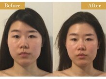 モモスパ(MOMOspa.)/頭蓋骨小顔矯正ビフォアフター